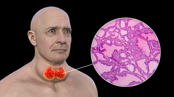 A 3D illustration of a man with enlarged thyroid gland and exophthalmos, alongside with a micrograph image of thyroid tissue affected by toxic goiter.