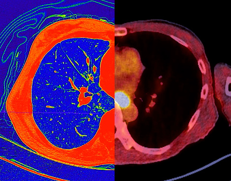 CT scan of Chest Axial view in color mode  and PET CT SCAN image.