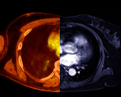 PET CT-SCAN and MRI in Axial view.