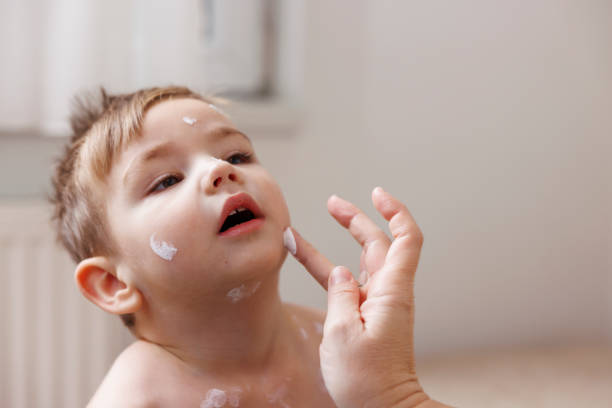Mother spreading ointment on toddler boy's chickenpox spots to prevent itching and scratching