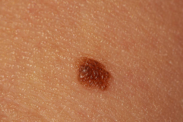 istock Macro of a mole on a child's body 1973133704