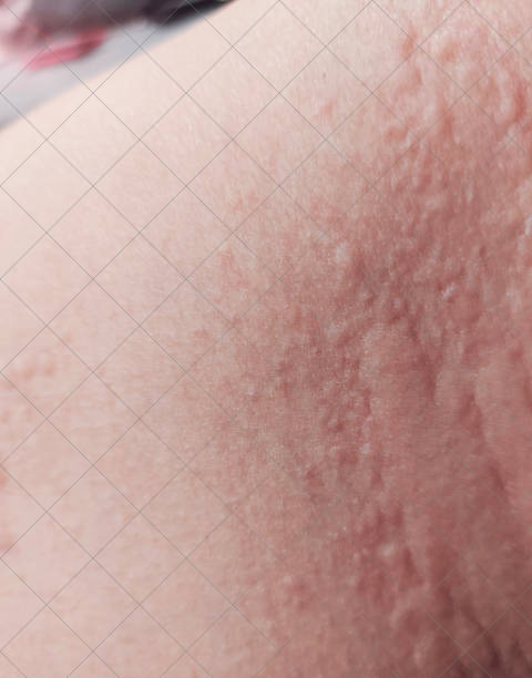istock Red rash on the skin caused by allergies. 1974706363