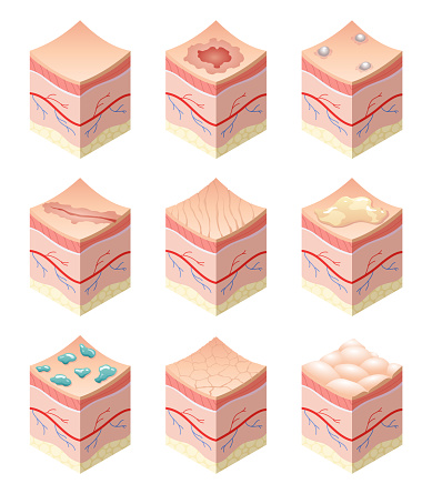 Skincare medical concept. Set of problems of different skin types in cross-section of human skin horizontal layers structure. Anatomy illustrative model layers of skin.