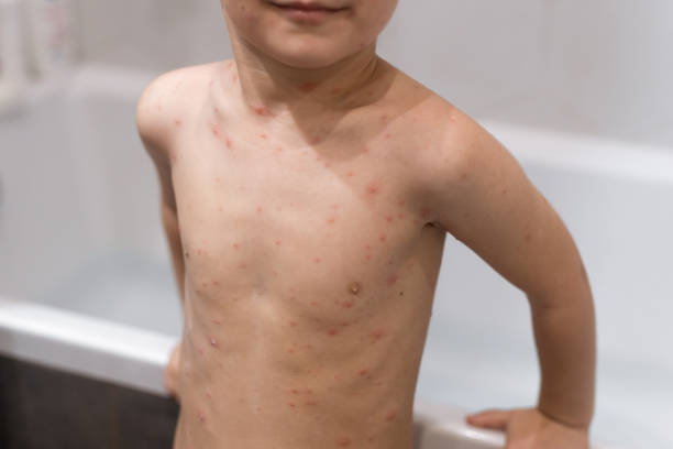 istock Boy with chickenpox. Rash on child body close up 1975028035