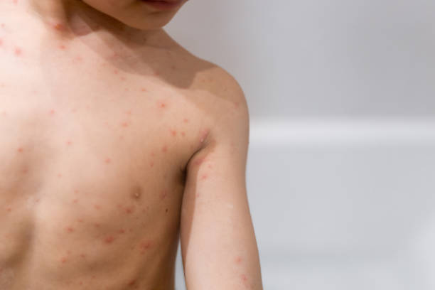 istock Boy with chickenpox. Rash on child body close up 1975029216