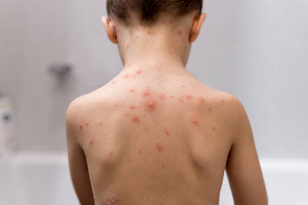 istock Boy with chickenpox. Rash on child body close up 1975030404
