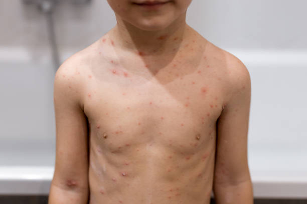 istock Boy with chickenpox. Rash on child body close up 1975030430