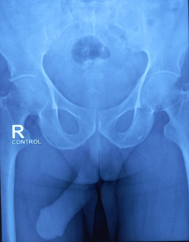 X-ray RGU, MCU. Short segment tight stricture at the proximal part of the anterior urethra. Long segment partial stricture with marginal irregular at the anterior part of penile urethra along with meatal stenosis.