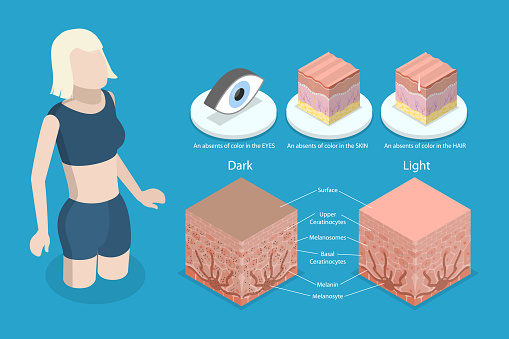 3D Isometric Flat Vector Conceptual Illustration of Albinism, Compared Normal Skin Cross Section with Lack of Melanocyte