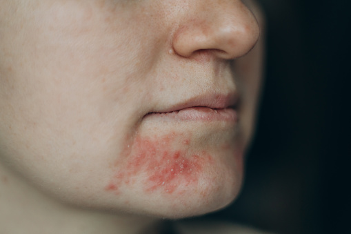 Perioral dermatitis on woman face. Closeup dermatitis on skin, ill allergic rash eczema skin of patient, atopic dermatitis symptom skin detail texture.