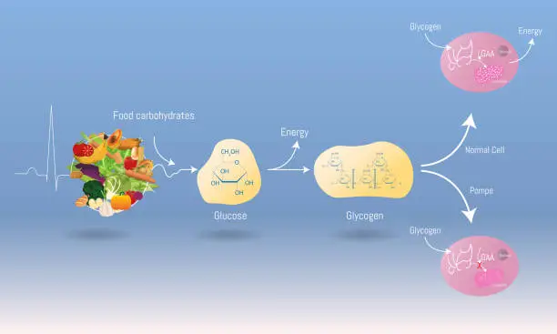 Vector illustration of Infographic of Pompe disease chemical process