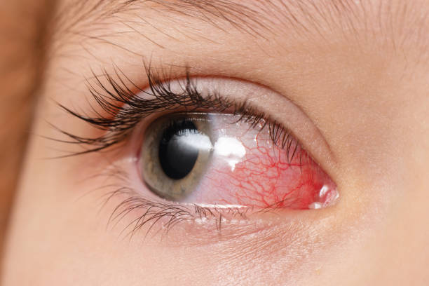 closeup irritated infected red bloodshot eyes, conjunctivitis - conjunctivitis sore eyes child human eye 뉴스 사진 이미지