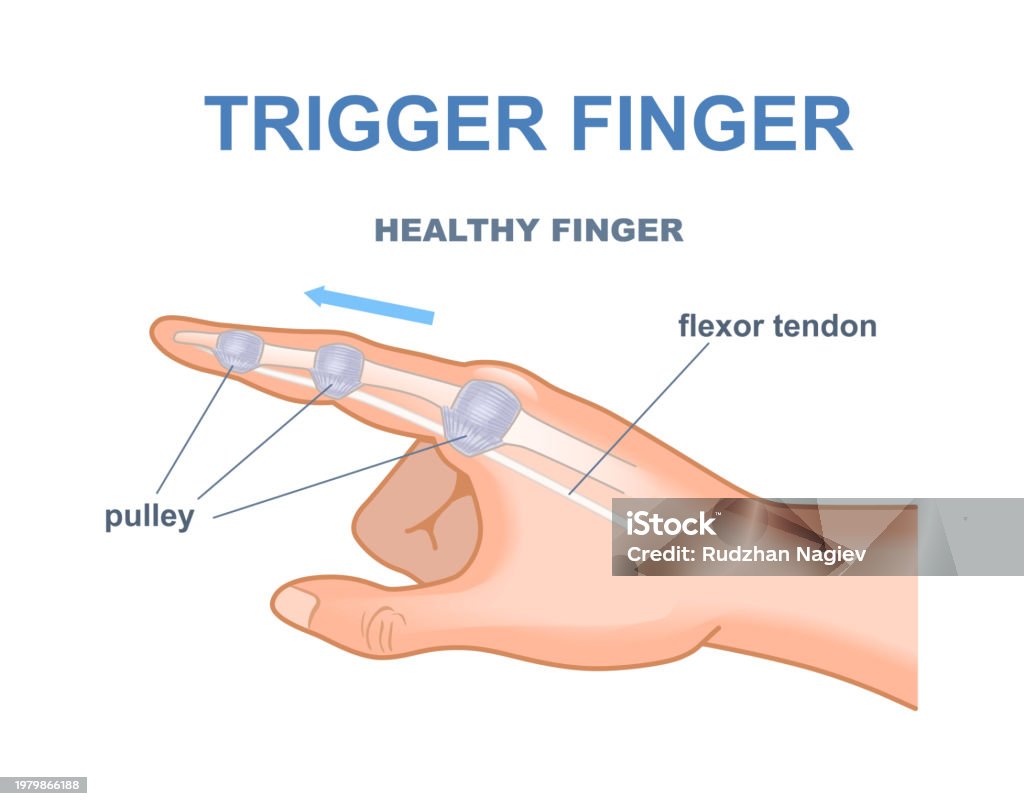 Trigger Finger Motion Trigger Finger Vector Concept Stock Illustration - Download Image Now ...