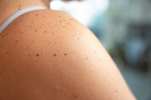 An intimate view of a woman's shoulder from behind, revealing the unique details of her skin adorned with nevi, ephelides (sunspots), and freckles. This image conveys the diversity and beauty of natural skin features, emphasizing the importance of skin care and sun protection