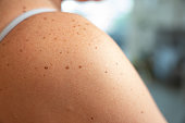 Skin Stories: Shoulder Details with Nevi, Ephelides, and Freckles