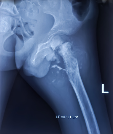 Radiografía de pelvis. Osteomielitis crónica que afecta a la diáfisis proximal y al cuello del fémur. Esclerosis desactivada. photo