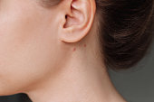 Young woman with the problem of acne. Pimples on the neck under the ear