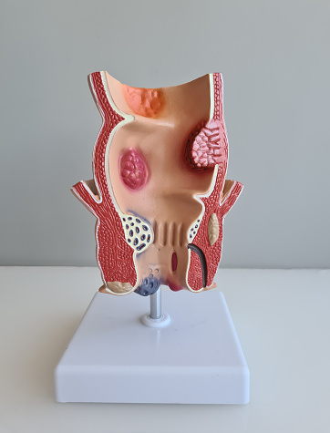 A highly detailed 3D printed model of colorectal cancer designed for medical education. Shows healthy colon and colon with polyps and tumors. Valuable tool for raising awareness.
