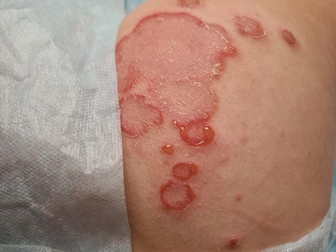 This image illustrates a child with atopic dermatitis on their arm, displaying red, weeping, and crusty skin, indicating discomfort and itching, typical symptoms of this form of eczema.