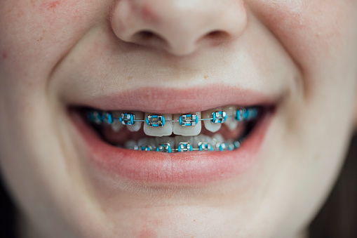 A close up of an unrecognisable teenage girl who is smiling and showing off the progress she has made with her fixed dental retainer. She has blue dental rubber bands fixed on the teeth.