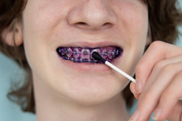 Purple Braces Purple Braces