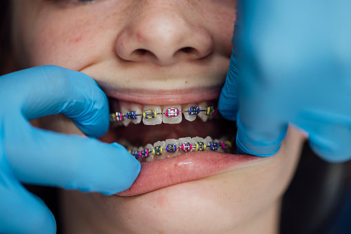 A close up of a teenage girl who is at an orthodontists appointment. She is having her fixed retainer checked and adjusted. Her retainer is a fixed brace with rubber bands in place to keep them progressing.