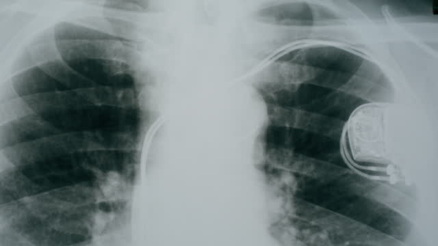 Lungs x-ray close-up. Doctor looking at ribs roentgen, human chest with cardiac pacemaker. Healthcare and medicine concept, checkup.