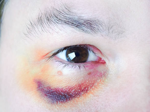istock Close-up man's bruised eye after injury 1991228894