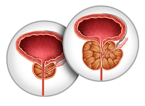 Enlarged Prostate organ gland as Benign Prostatic Hyperplasia as a urology medical illustration concept for part of the male reproductive anatomy and lower urinary tract symptoms.