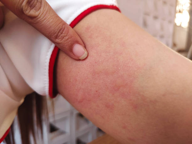 istock Red rash on the skin caused by allergies. 1992041410