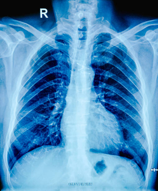 istock X-ray of the human chest. Post CABG state. 1992766501