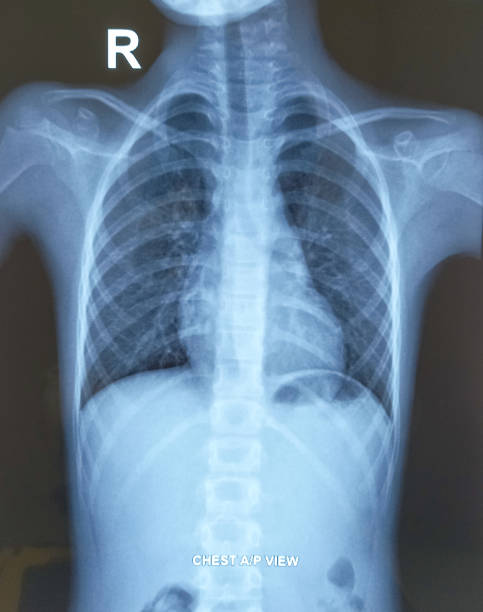 istock X-ray of the 8 years human chest. 1992766505