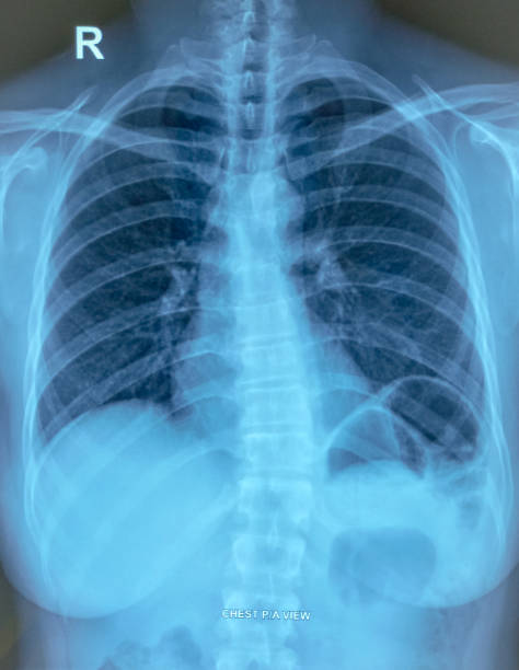 istock X-ray of the human chest. 1992767392