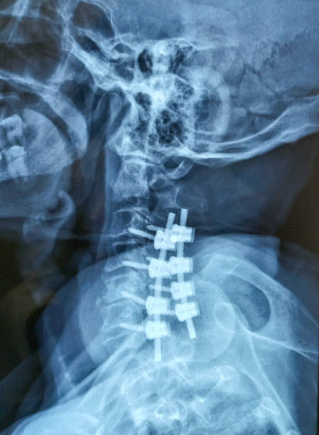 X-ray of the human cervical spine. Cervical spondylosis. Evidence of previous surgery with metallic fixators at C3-C6 levels. Marginal osteophytes are noted in the cervical vertebrae. No cervical rib is noted.