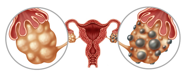 Polycystic Ovarian Syndrome or PCOS on ovaries symptoms as hormonal disorder with small ovarian cysts as a concept of female fertility or infertility with fallopian tubes.
