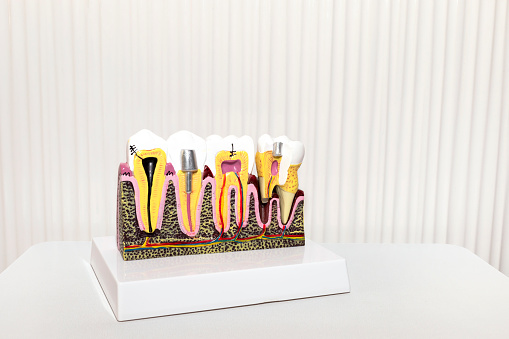 Dental Tooth Implant, Bridge Or Crown Model On White Background in Dental Office, Copy Space. Dummy Mockup Human Jaw Oral Dentures. Prosthesis On Metal Peg. Horizontal Plane. Dentistry, Education