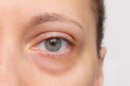 The face of a young woman with a bag under her eye close-up. Swelling of the lower eyelid. Bruises and dark circles appear from insomnia, stress, depression, overwork and fatigue. Unhealthy appearance