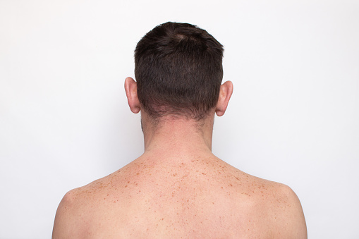 Age or pigment spots, moles and freckles on the back and shoulders of an adult man, close-up. Pigmentation on the body and skin. Liver spots, lentigo, sun spots. Cosmetology and beauty concept