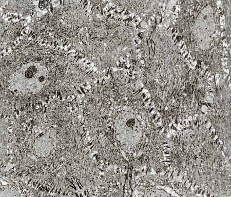 Epidermis. Electron microscope micrograph of an epidermis spinous layer. The keratinocytes show polygonal shapes, central nucleus with nucleolus, cytoplasm full of keratin filament bundles, and numerous desmosomes crossing the intercellular spaces.