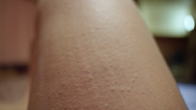 Eczema occurring at night on an Asian mid-adult woman's leg while traveling in the forest, it happening extremely when scratching