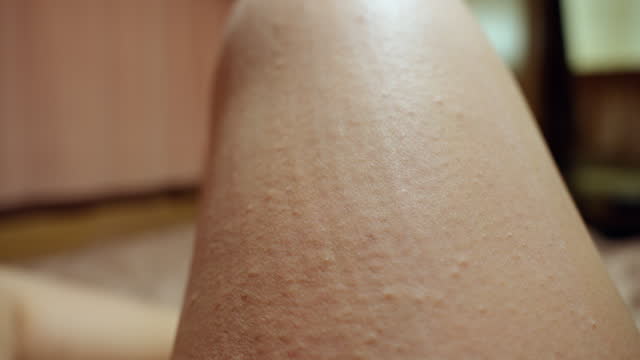 Eczema occurring at night on an Asian mid-adult woman's leg while traveling in the forest, it happening extremely when scratching