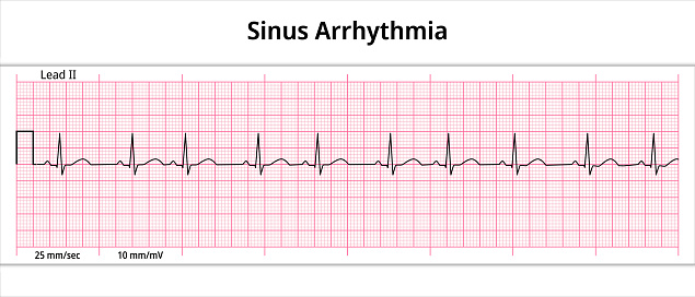 ECG Sinus Arrhythmia - 8 Second ECG Paper - Electrocardiogram Vector Medical Illustration