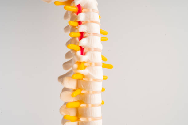 lumbar spine displaced herniated disc fragment, spinal nerve and bone. model for treatment medical in the orthopedic department. - slipped disc fotografías e imágenes de stock