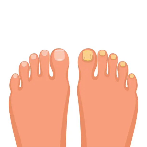 Vector illustration of Nail disease. Onychomycosis concept. Fungal nail infection. Vector.