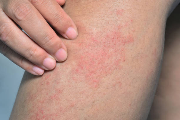 istock Red allergic rash on the leg skin from Atopic dermatitis. 2006598052