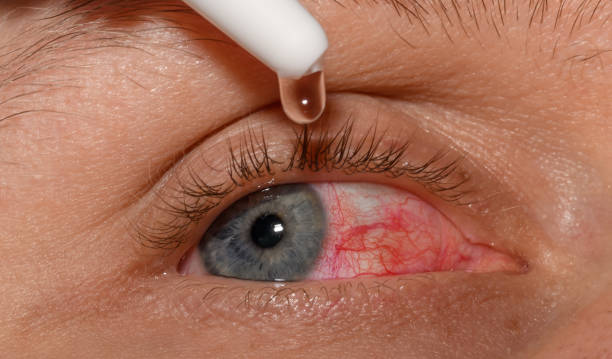 istock Moisturizing drops instilled into the eye from close up, red, irritated eyes 2007169844