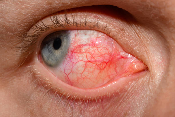istock Very bloodshot eye with visible blood vessels 2007171445