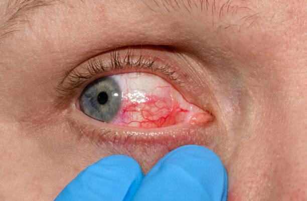 istock Human open bloodshot dry eye with visible red veins 2007171992