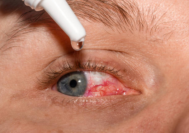 applicare gocce idratanti su un occhio aperto e arrossato con capillari rotti - human eye dry eyedropper tired foto e immagini stock
