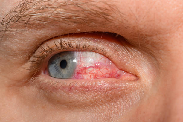 istock Dramatically bloodshot eye in a young man with conjunctivitis 2007173081
